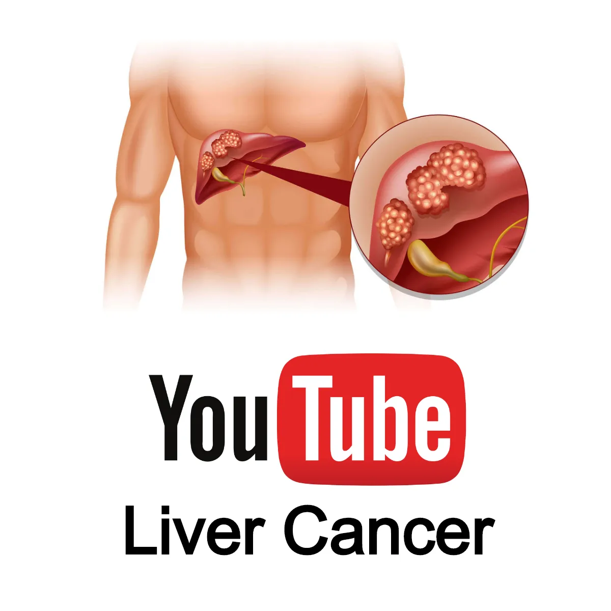 Liver Cancer