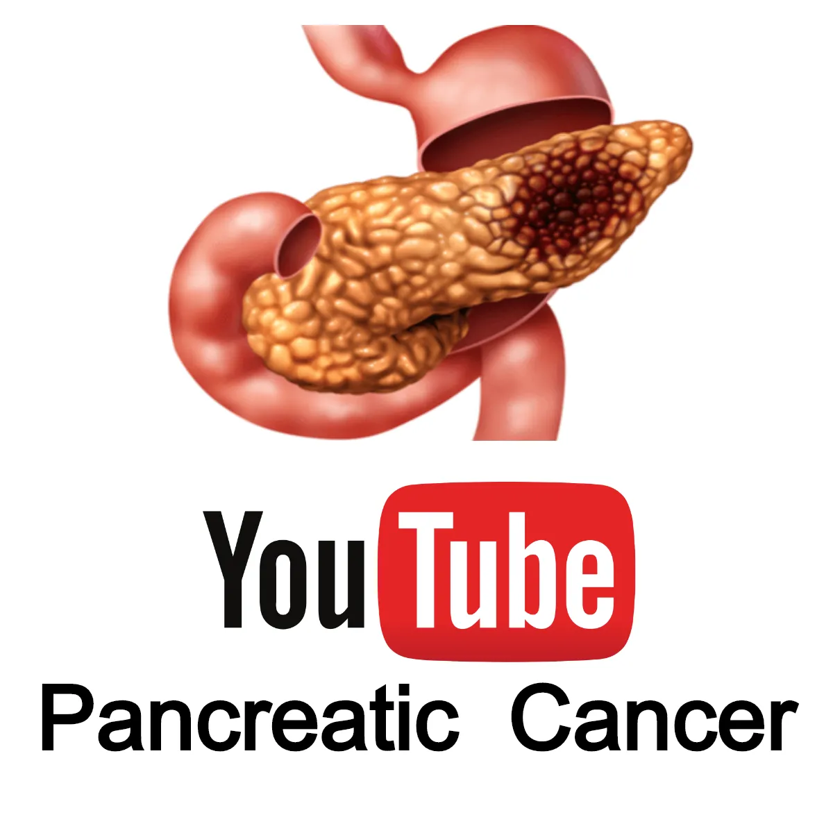 Pancreatic cancer